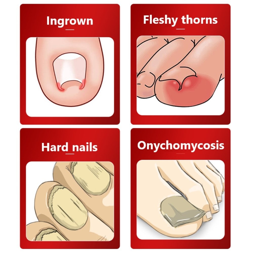 Toe Nail Clippers Nail Correction Thick Nails Ingrown Toenails Nippers